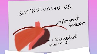 Gastric volvulus surgeryeducation mbbsneetpgmedicine [upl. by Franklin568]