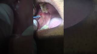 Removal of Leukoplakia Patch using RF Electrosurgery Unit Dr Ankit Goel Hapur [upl. by Brose]