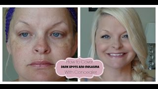 How to Cover Dark Spots  Melasma with Concealer [upl. by Menides79]