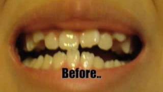 Braces 2 MONTHS watch my updated FULL braces time lapse [upl. by Colfin512]