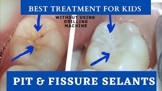 Pit and Fissure sealants  kids cavity Filling  child tooth filling  dental treatment for kids [upl. by Nytsirc]