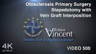 Otosclerosis Primary Surgery Stapedotomy with Vein Graft Interposition [upl. by Nussbaum]