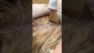 Scalp Treatment for Dandruff Removal [upl. by Iccir]