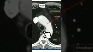 Scanner thoracique T4 anatomy medecine science anatomie scanner radiology radiologie [upl. by Hoopes644]