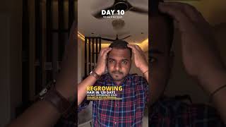 Using Derma roller and Minoxidil for Hair growth  Day 10 minoxidil dermaroller hairloss hair [upl. by Amitarp226]