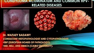 CONDYLOMA ACUMINATUM AND COMMON HPV RELATED LESIONS BY Dr WAFAEY BADAWY [upl. by Broeker]