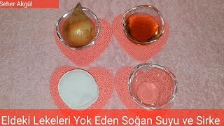 Güneş Lekeleri ve Yaşlılık Lekelerine Soğan Suyuyla Kesin Çözüm [upl. by Hyacinthia717]