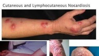 Norcardia Bacteria Infections caused by Norcardia Asteroides and Norcardia Brasiliensis [upl. by Suvart]