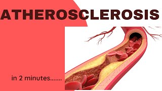 Atherosclerosis in 2 minutes [upl. by Odlanra]