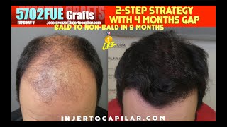 5702Grafts FAPD NWV 2step strategy From bald to nonbald in 9mths 25amp 23hgSR96 29442023 [upl. by Cerf]