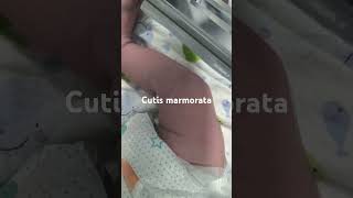 Cutis marmoratanewborn paeds clinical [upl. by Eduam]