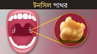 টনসিল পাথর  Tonsil Stone  3D Animation [upl. by Libnah]