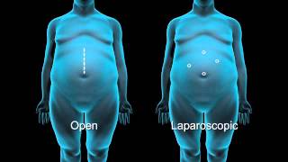 How Bariatric Surgery Works [upl. by Tarah733]