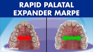 Rapid PALATAL expander MARPE  This ORTHODONTIC device can EXPAND the PALATE in adults© [upl. by Maribelle]