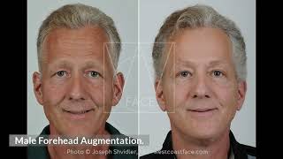 Facial Plastic Surgery for Men Seattle WA  Joseph Shvidler MD [upl. by Hansiain]