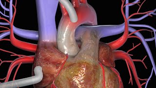 KoronararterienBypass CABG [upl. by Eirhtug]