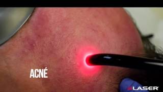 KLASER BLUE DERMA 445nm  Acne Applications [upl. by Nalyr]