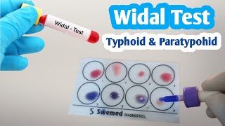 Widal Test  Salmonella Typhi amp Paratyphi Full Procedure  Typhoid fever [upl. by Clarisa180]