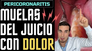 MUELA del JUICIO SALIENDO con dolor e inflamada  Así se ve una PERICORONARITIS [upl. by Ujawernalo]