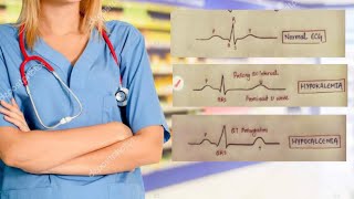 ECG changes in electrolyte imbalance  Normal ECG  Hyperkalemia Hyponatremia [upl. by Nawuj336]