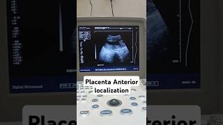 Placenta anterior locationshortyoutubevideo shortvideo plzzsubscribe [upl. by Sylirama]