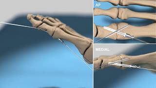 1st Metatarsophalangeal Joint Arthrodesis with ActivaScrew™ Cannulated [upl. by Vivianne220]