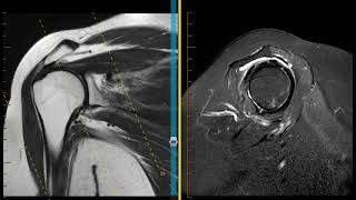 Shoulder impingement with rotator cuff tendinopathy and labral tear [upl. by Esinehc817]