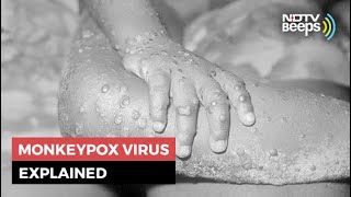 Monkeypox 5 Things You Should Know About This Rare Virus [upl. by Airbmat]