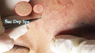 Knife Skills To Remove Acne  Kỹ Thuật Lấy Mụn Ẩn Tại Sắc Đẹp Spa [upl. by Yorgos]