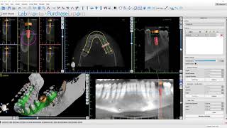 Treatment Planning with Out of Library Implants and Surgical Kits [upl. by Anirbac435]