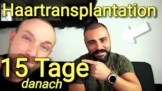 Haartransplantation Türkei Vorher Nachher 15 Tage😱 Gencay [upl. by Elumas]