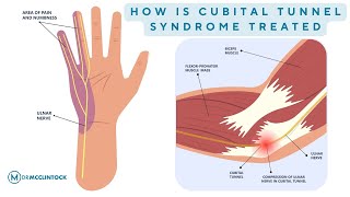 How Is Cubital Tunnel Syndrome Treated  Dr Kyle McClintock [upl. by Royall]