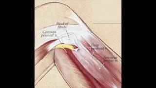 Dorsiflexor weakness [upl. by Chinua]