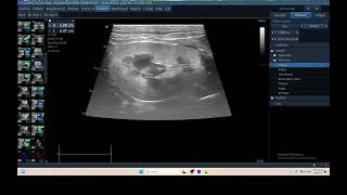 IQ 325 KIDNEY ULTRASOUND ECHOPAC ANALYSIS CRF ELASTOGRAPHY 2 [upl. by Tayib]