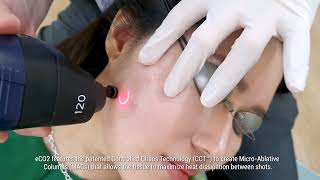 Co2 Fractional Laser Treatment [upl. by Demmy]