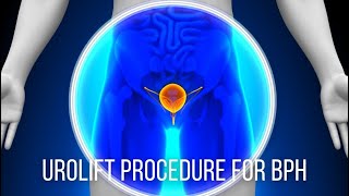 UroLift Procedure for BPH  Dr David Harris [upl. by Owens]