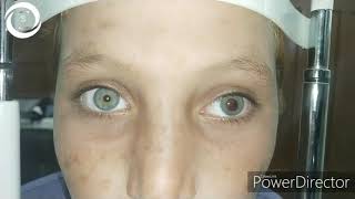 Anisocoria 1 traumatic [upl. by Misak]