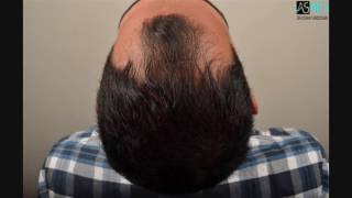 Manual FUE Hair Transplant Before amp After 4808 24062402 Grafts Result ASMED  Dr Koray Erdogan [upl. by Bernt334]