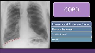 Chest Xray with Black lung field COPD Pneumothorax amp Bullae cxr radiology [upl. by Akema177]