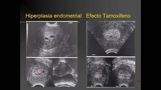 28 y 29 HIPERPLASIA DE ENDOMETRIOADENOCARCINOMADR SANCHEZ [upl. by Samot]