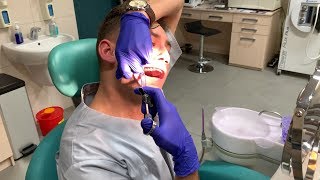 Self Extraction Wisdom Tooth 18 [upl. by Anaitsirhc703]