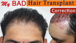 BAD Hair Transplant Correction at Medispa By Dr Suneet Soni  Failed Hair Transplant Repair [upl. by Adnertal]