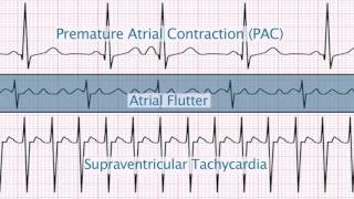 quotSupraventricular Arrhythmiasquot by Christine LaGrasta MS RN CPNP PCAC for OPENPediatrics [upl. by Suivatram]