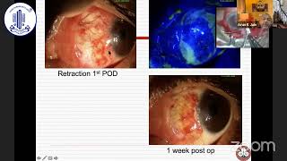 Complications of Pterygium surgery and management  Dr ARUN KUMAR JAIN [upl. by Ahsyt]