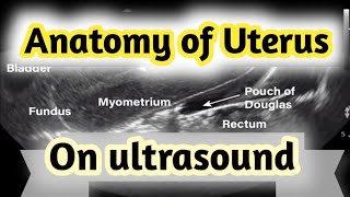 Sonographic Anatomy of UterusGyneacological ultrasound [upl. by Htessil]