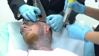 Crazy Video of Man Getting Face Tattoo Removed [upl. by Anirok121]