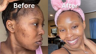 How I Cleared My Acne  Dark Spots  Hyperpigmentation for good in 1 month NO ACCUTANE VIDEO PROOF [upl. by Dare]