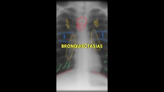 Bronquiectasias no RX [upl. by Hugo]