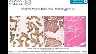 Introduction to Myopathies and Muscular Dystrophy [upl. by Sibley]