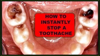 INSTANT TOOTHACHE RELIEF NATURAL TOOTHACHE REMEDIES 100  EFFECTIVE Khichi Beauty [upl. by Haissem]